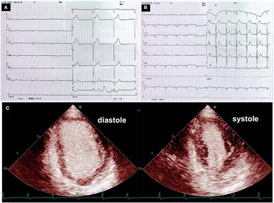 Successful Therapy for Myocarditis Concomitant With Complete Heart Block After Pembrolizumab Treatment for Head and Neck Squamous Cell Carcinoma: A Case Report With Literature Review